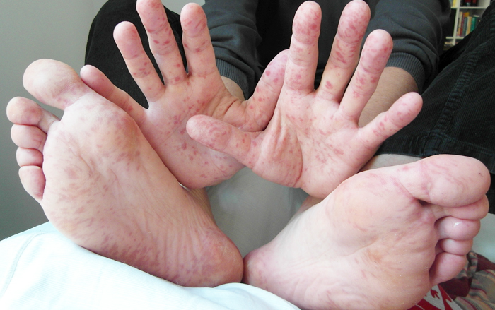 โรคมือเท้าปาก โรคระบาดพบบ่อยในเด็กที่มาพร้อมกับฤดูฝน